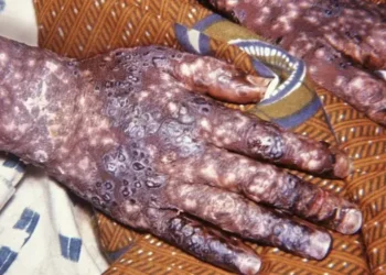 Kinshasa reçoit 200 000 doses de vaccin contre la variole du singe : une riposte en marche en Afrique