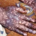 Kinshasa reçoit 200 000 doses de vaccin contre la variole du singe : une riposte en marche en Afrique